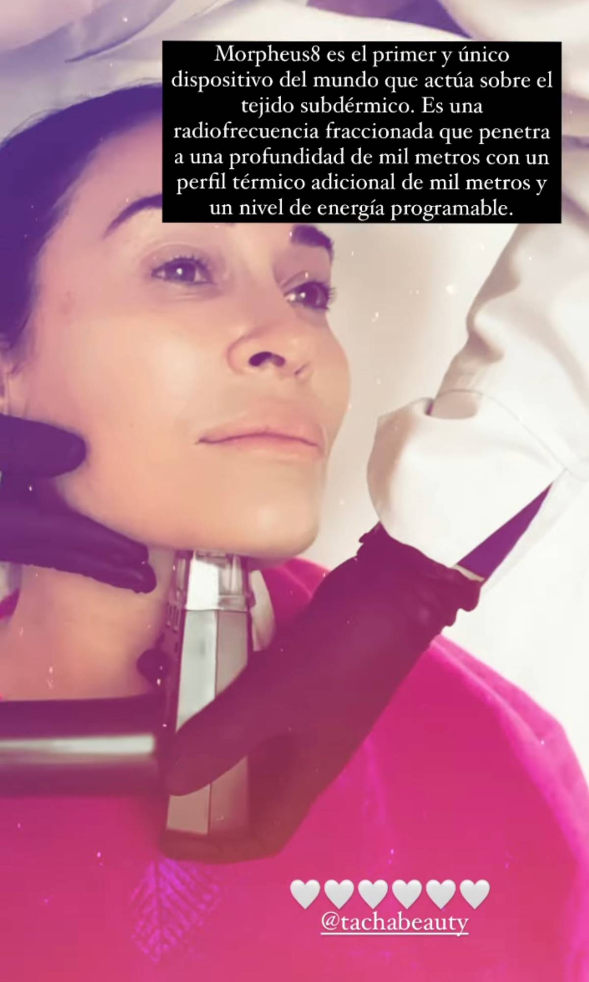 Vicky Martín Berrocal tratamiento facial